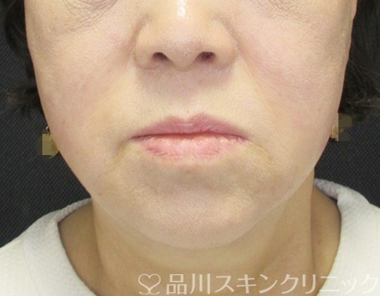 症例NO.70405のAFTER写真