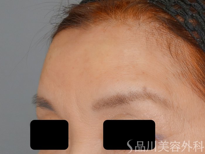 症例NO.70146のAFTER写真