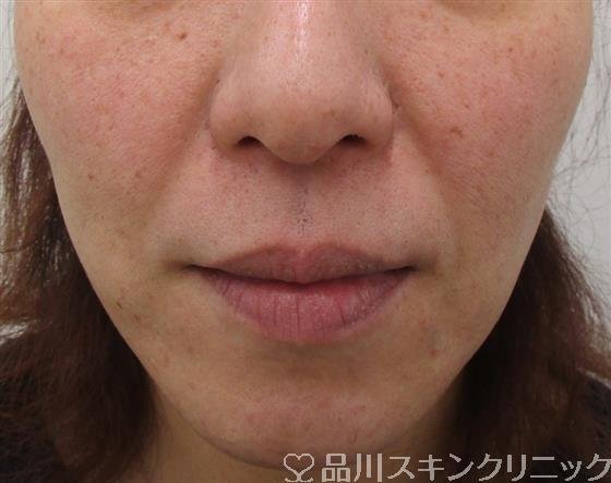 症例NO.41444のBEFORE写真