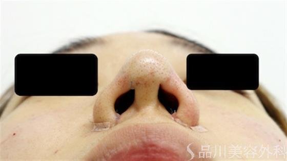 症例NO.23988のAFTER写真