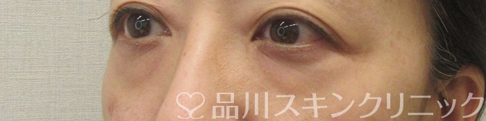 症例NO.71049のBEFORE写真