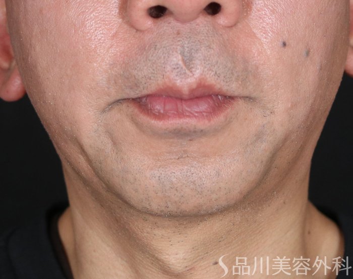 症例NO.73477のBEFORE写真