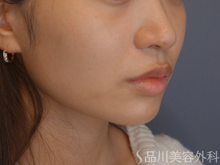 症例NO.74725のBEFORE写真