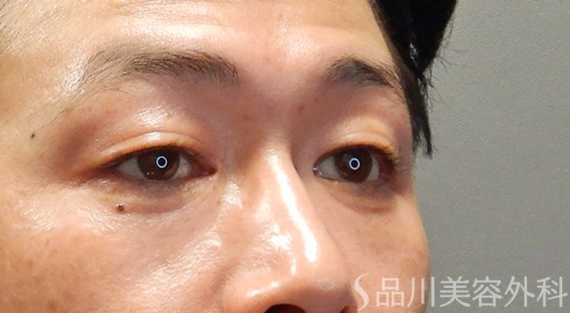 症例NO.74900のAFTER写真