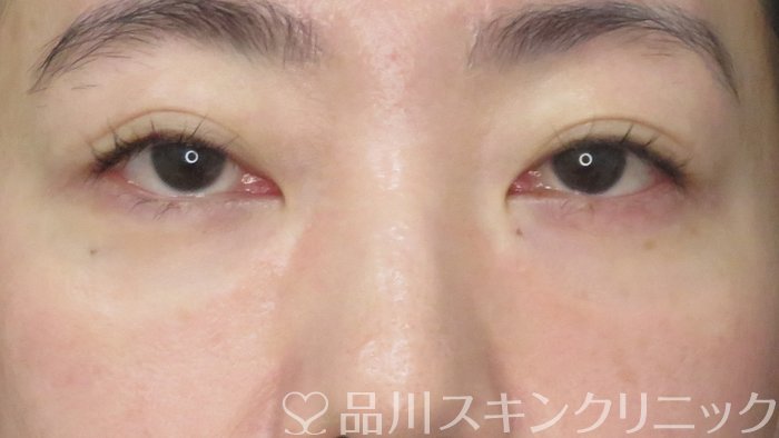 症例NO.72312のBEFORE写真