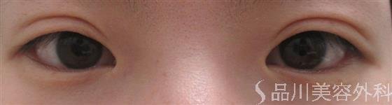 症例NO.21613のBEFORE写真