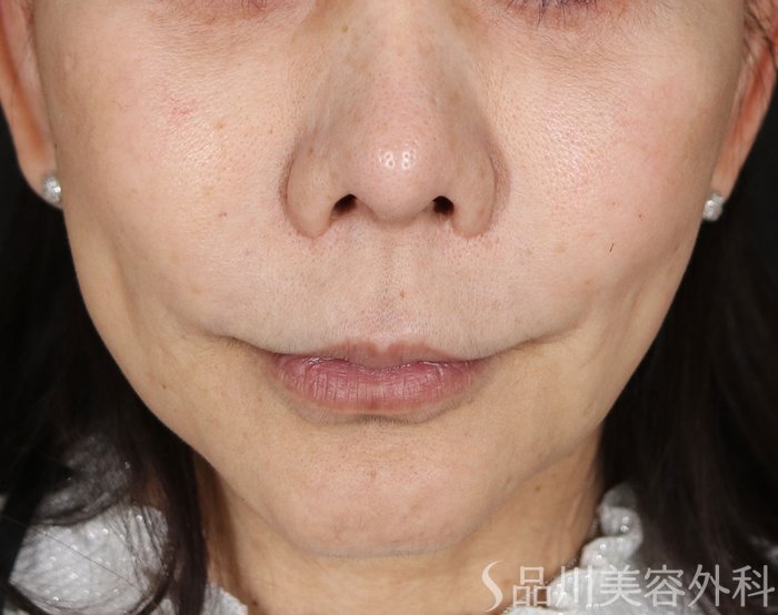 症例NO.72058のBEFORE写真