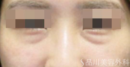症例NO.74466のBEFORE写真