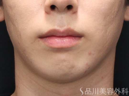 症例NO.75181のBEFORE写真