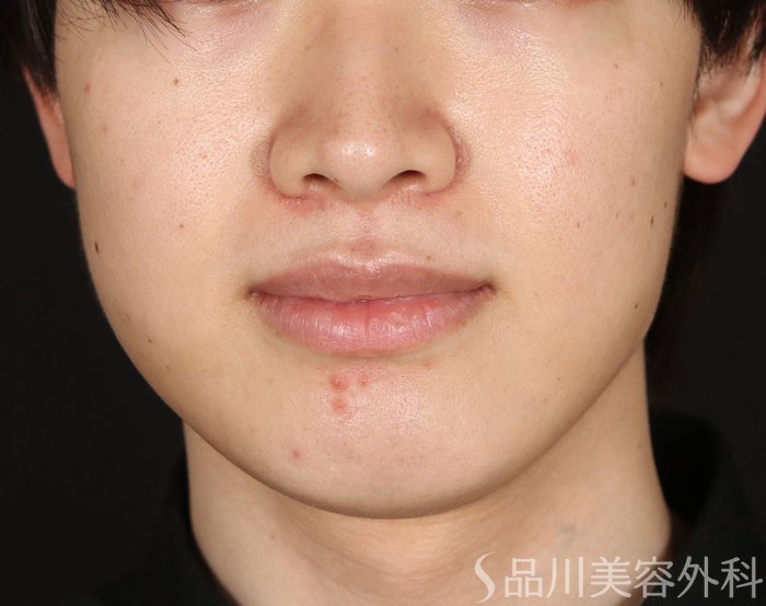 症例NO.73266のAFTER写真