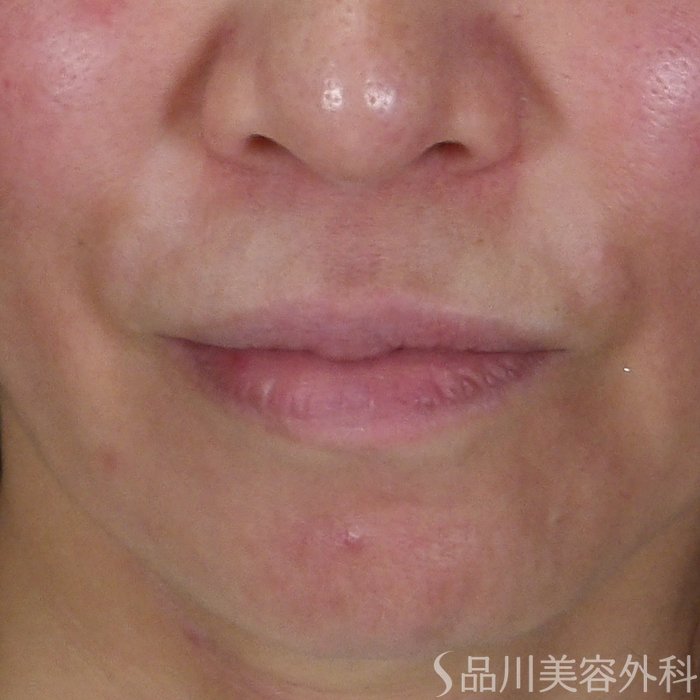 症例NO.70804のBEFORE写真