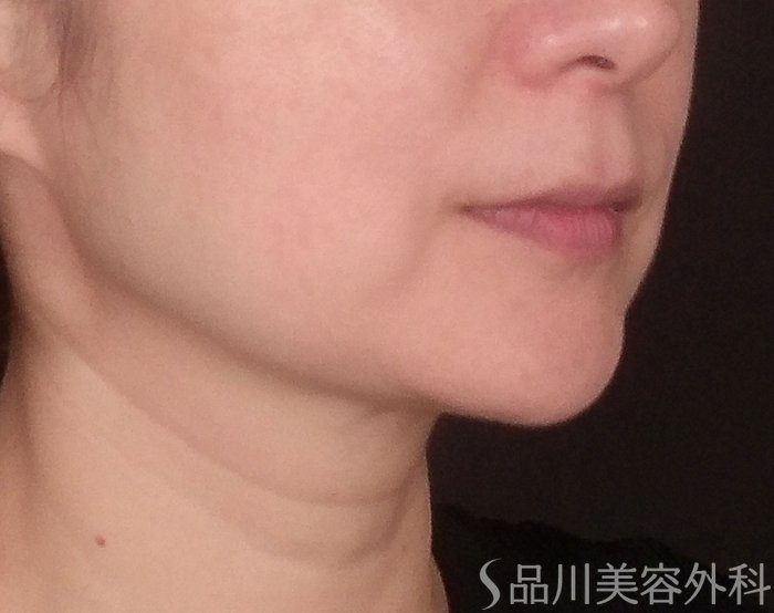 症例NO.71046のBEFORE写真