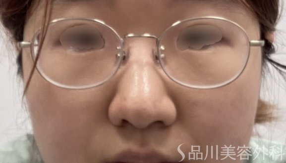 症例NO.72684のAFTER写真