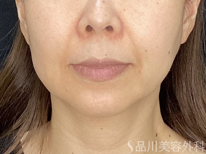 症例NO.71785のBEFORE写真