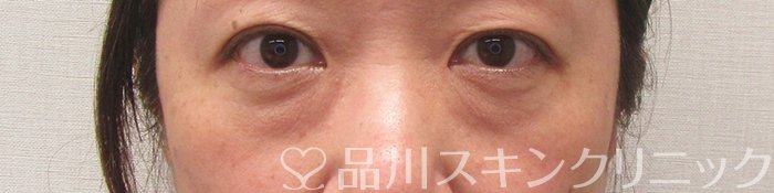 症例NO.69972のBEFORE写真