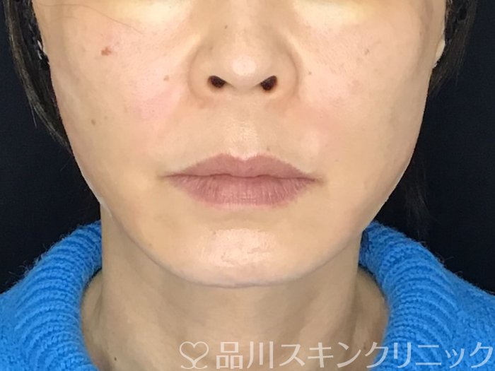 症例NO.69593のAFTER写真