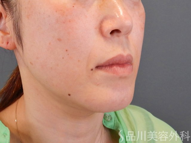 症例NO.75296のBEFORE写真