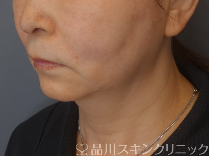 症例NO.72260のAFTER写真