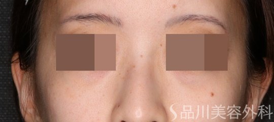 症例NO.74997のBEFORE写真