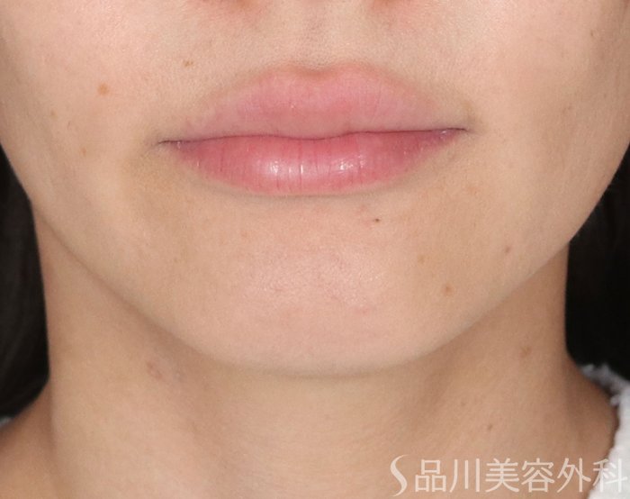 症例NO.72452のBEFORE写真