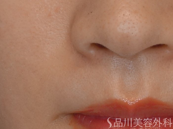 症例NO.72275のAFTER写真