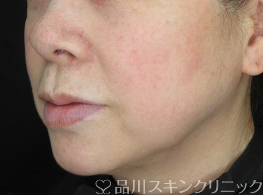 症例NO.70042のBEFORE写真