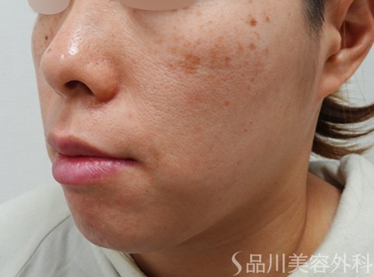 症例NO.71189のBEFORE写真