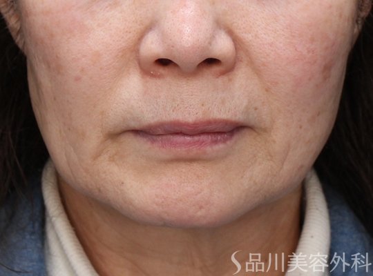 症例NO.73619のBEFORE写真