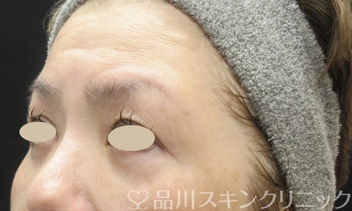 症例NO.69364のAFTER写真