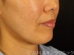 症例NO.72355のBEFORE写真