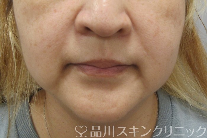 症例NO.70581のBEFORE写真