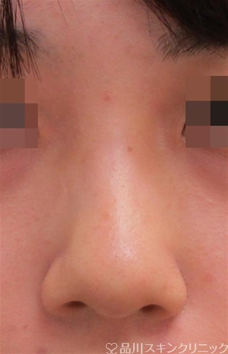症例NO.30559のBEFORE写真