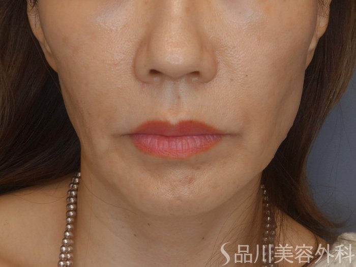 症例NO.72060のBEFORE写真