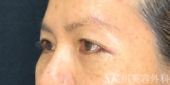 症例NO.73041のAFTER写真