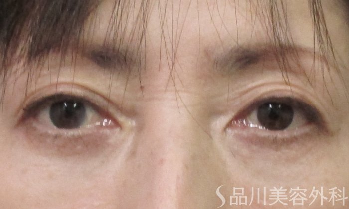 症例NO.65324のAFTER写真