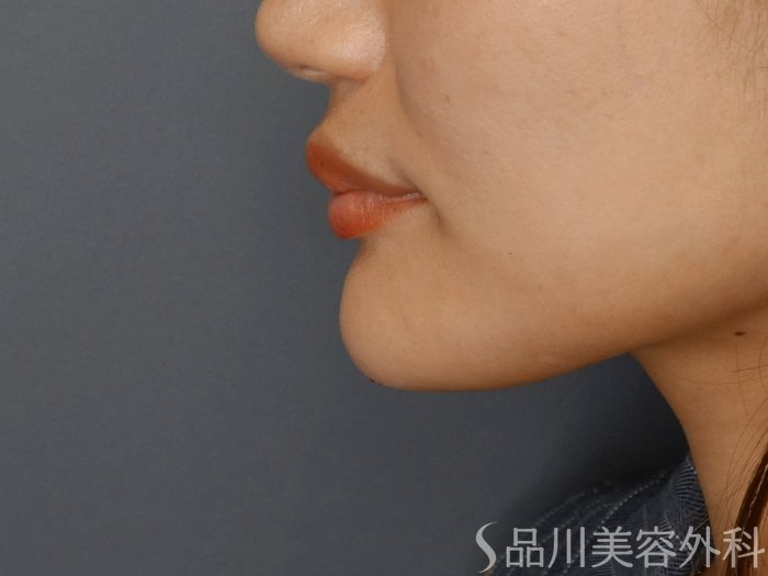 症例NO.71489のAFTER写真