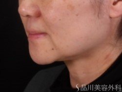 症例NO.72353のBEFORE写真