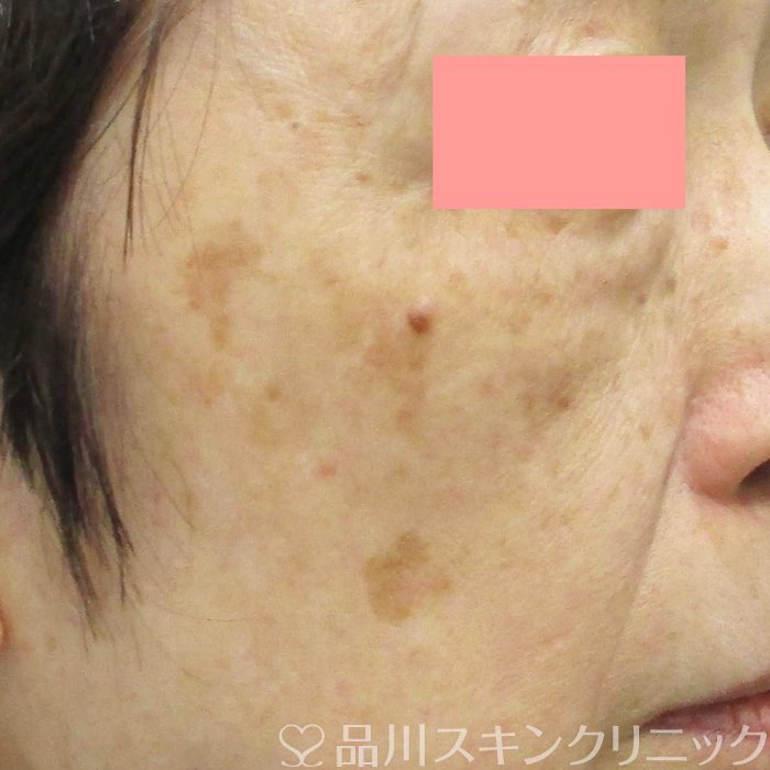 症例NO.71503のBEFORE写真