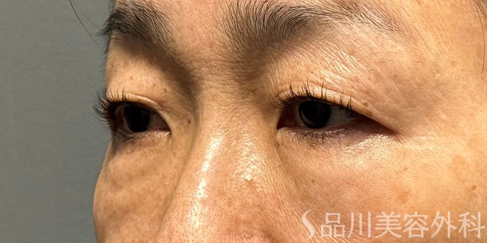 症例NO.68947のBEFORE写真