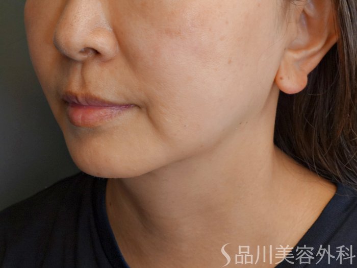 症例NO.71940のBEFORE写真