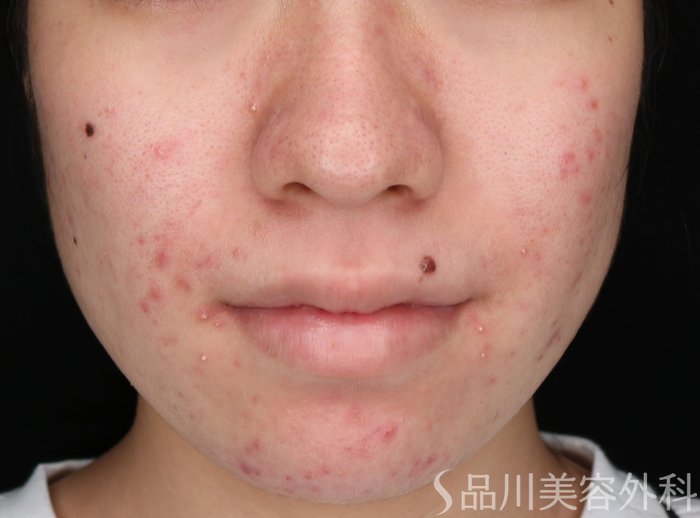 症例NO.73377のBEFORE写真