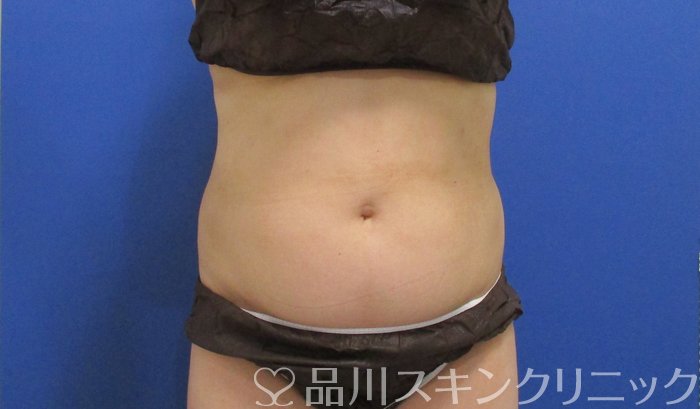 症例NO.70336のAFTER写真