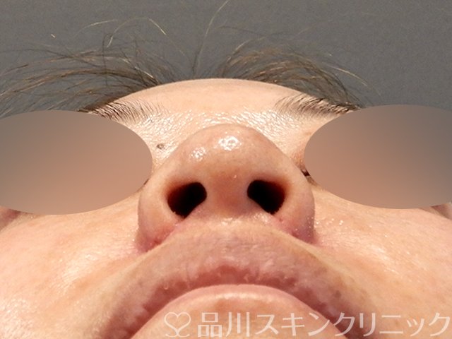 症例NO.68613のAFTER写真