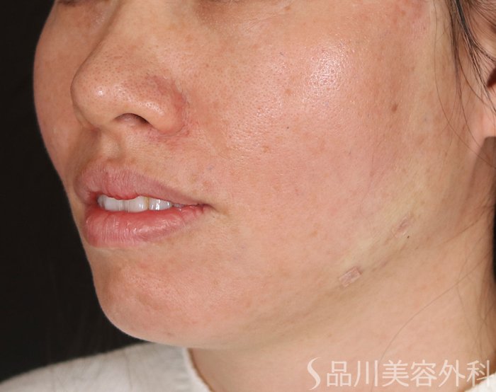 症例NO.72201のAFTER写真