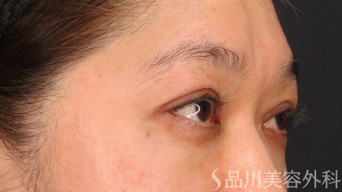 症例NO.63536のAFTER写真