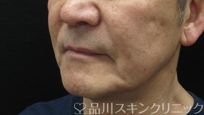 症例NO.69765のBEFORE写真