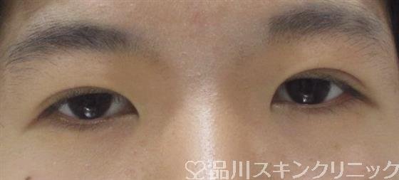 症例NO.34397のAFTER写真