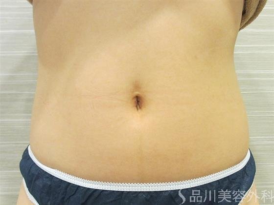 症例NO.23308のAFTER写真