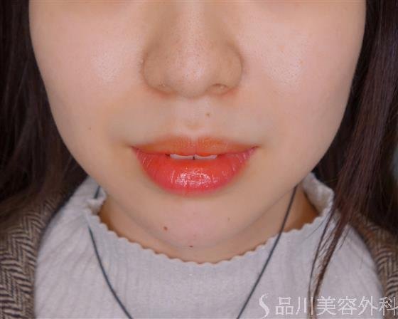症例NO.52958のAFTER写真