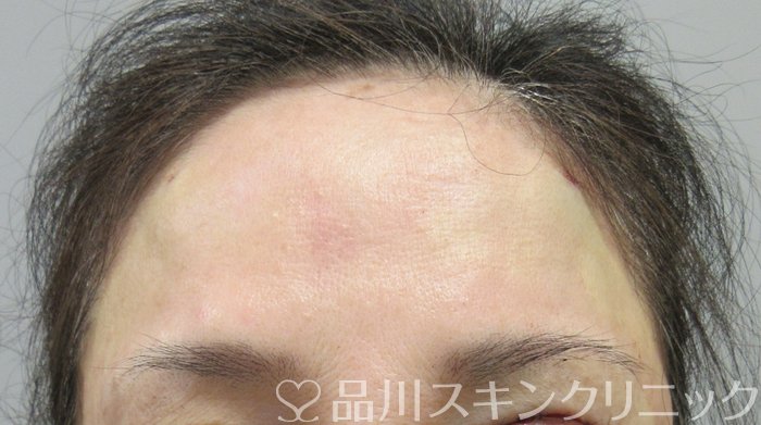症例NO.74418のAFTER写真